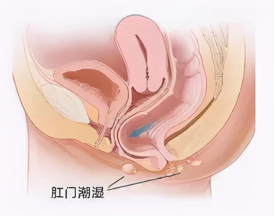 运城众泰肛肠医院：肛门湿疹是怎么回事？