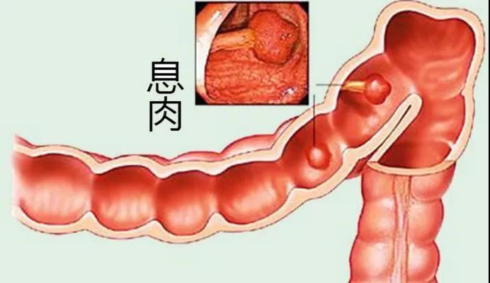 运城众泰肛肠医院：检查出结肠携欧，一定要切除吗？