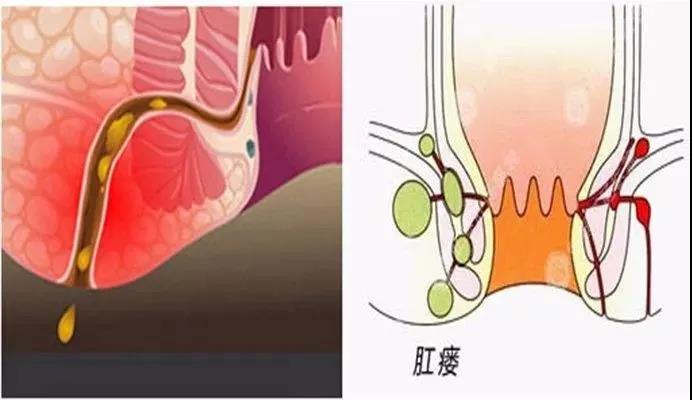 运城众泰肛肠医院：哪些明显的肛瘘症状容易被感知到？