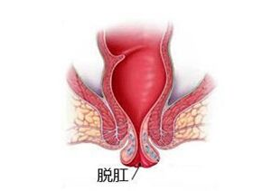 运城众泰肛肠医院：儿童脱肛可自愈，成人脱肛一定要及时就医！