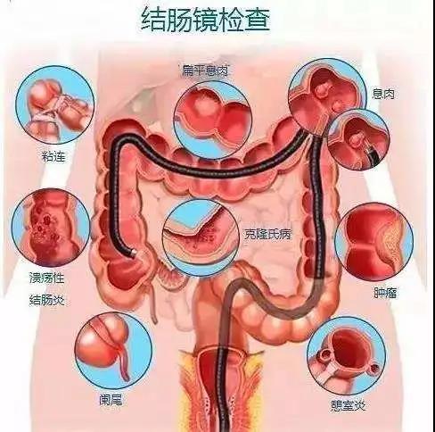 运城众泰肛肠医院：肠息肉会癌变吗？切还是不切？