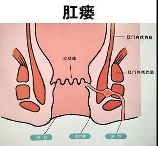 运城众泰肛肠医院：肛周脓肿一拖再拖，警惕变成肛瘘！