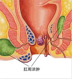 运城众泰肛肠医院：肛周脓肿拖来拖去都是祸