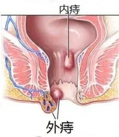 运城众泰肛肠医院：外痔会慢慢变小吗?