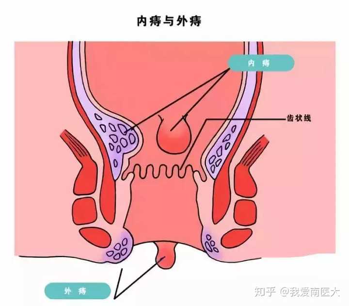运城众泰肛肠医院：内痔是怎么回事?