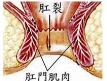 运城众泰肛肠医院：肛裂，你所应该知道的