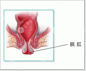 运城众泰肛肠医院：脱肛的原因是什么？