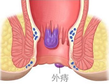 运城众泰肛肠医院：外痔不治疗会带来哪些危害？