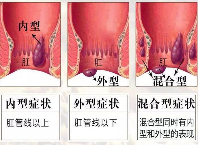 运城众泰肛肠医院：混合痔，不能小看的疾病