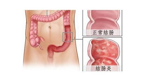 运城众泰肛肠医院：结肠炎常识您需要了解一下！