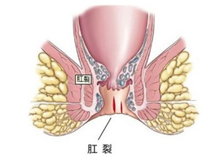 运城众泰肛肠医院：肛裂，你所应该知道的