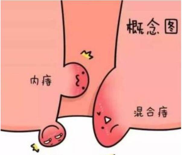 运城众泰肛肠医院：什么是混合痔？