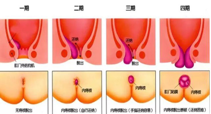 运城众泰肛肠医院：痔疮能自愈吗？