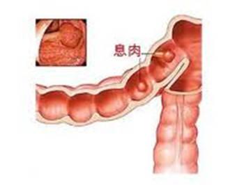 运城众泰肛肠医院：肠息肉是什么原因引起的？