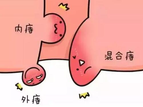 混合痔一定要手术吗？