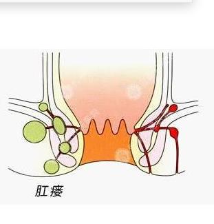 运城众泰肛肠医院：一般肛瘘都有这五个症状
